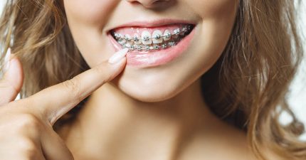 ¿Cuántos tipos de brackets existen y cuáles son?