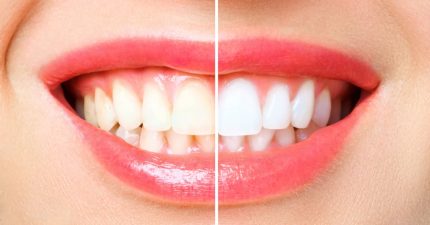Qué es el blanqueamiento dental