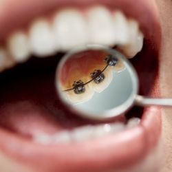 Clínica Dental Sedano | Ortodoncia lingual