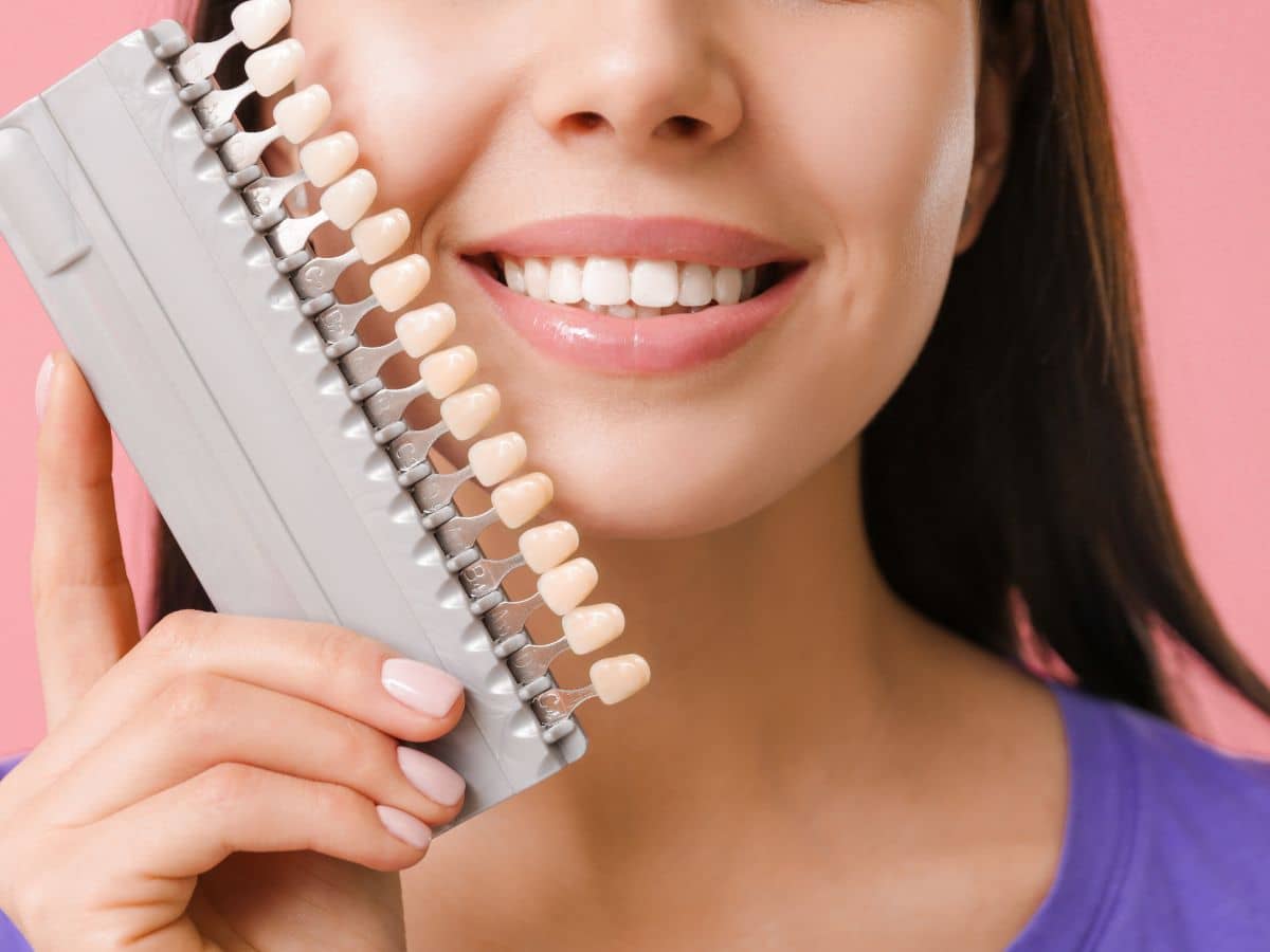 Por qué las carillas dentales se manchan