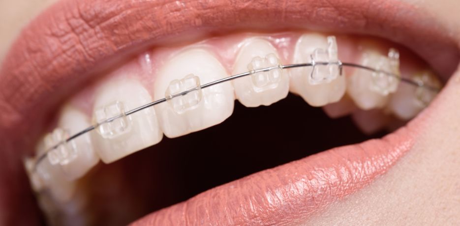 ventajas de los brackets estéticos