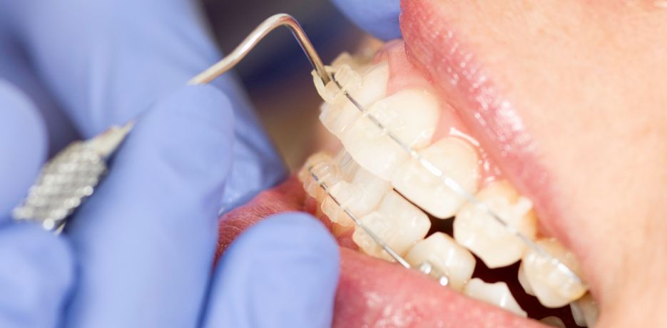 qué son los brackets estéticos