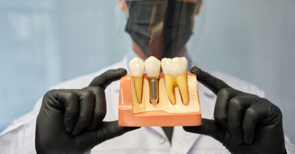 Implantes dentales: complicaciones a largo plazo