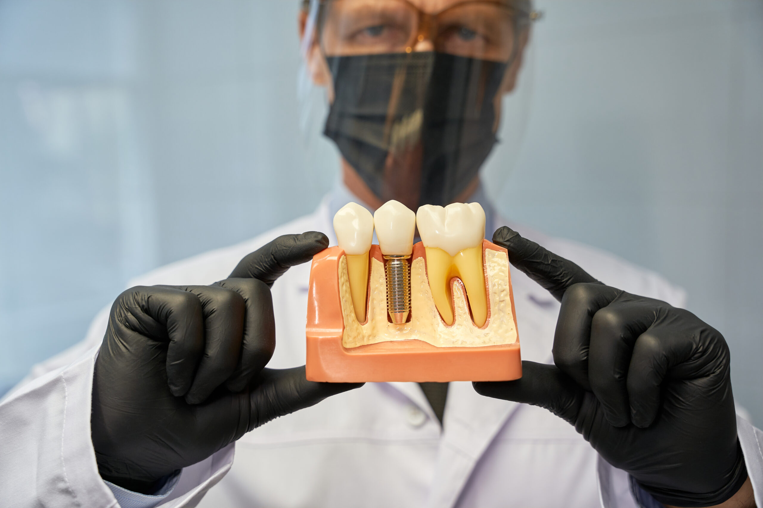 Implantes dentales: complicaciones a largo plazo