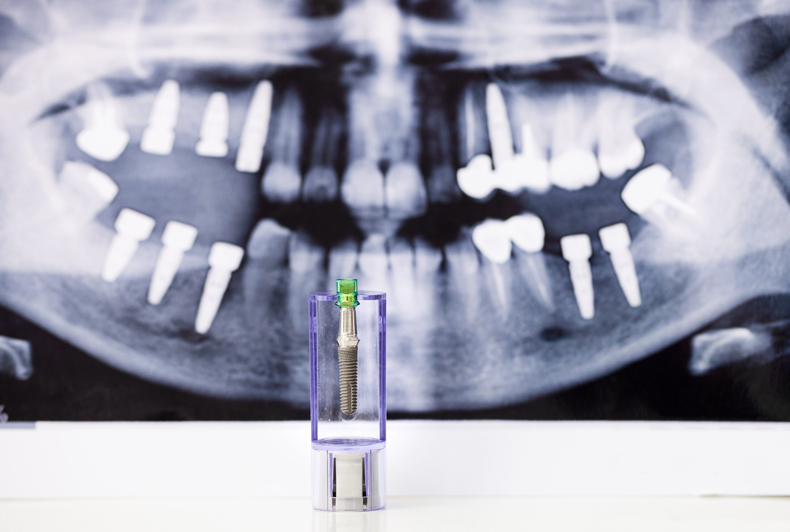 complicaciones implantes dentales