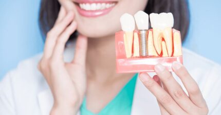 sonrisa implante dental